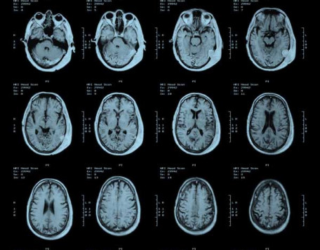 Mind 05 MRI brain scan